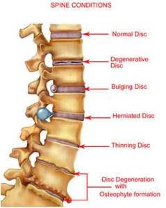 Physical Therapy For Bulging Discs | Suwanee Ga